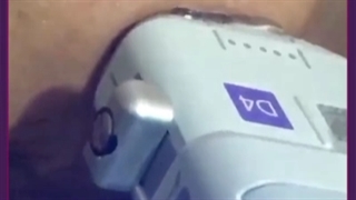 هایفوتراپی پلاستیک لثه