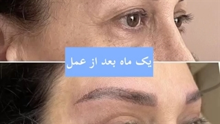 نمونه کارهای بلفاروپلاستی غرب کلینیک