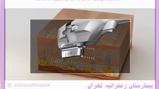 میزان ماندهگاری هایفوتراپی چقدر است؟