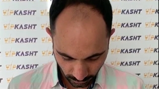 نتیجه یک سال بعد از کاشت مو - کلینیک کاشت مو vip