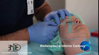 رفع چین و چروک پوست با دستگاه پزشکی Carboxy Therapy