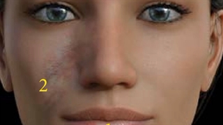 پنج علامت مهم ایسکمی پس از تزریق ژل .دکتر ابراهیم مقیمی