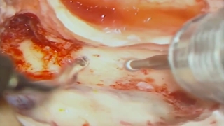 علت و درمان فلج دو طرفه صورت