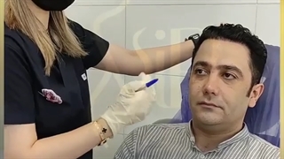 جوانسازی صورت با تزریق فیلر به لب- کلینیک vip تهران