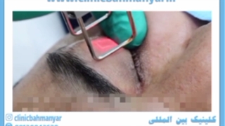 بلفاروپلاستی با لیزر امکان پذیر است؟