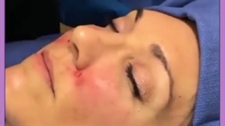 چاق کردن صورت در کلینیک بین المللی آراد