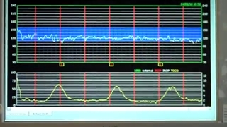 دستگاه پایش جنین یا فتال مانیتورینگ