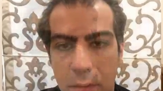 کاشت مو