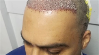 کاشت مو