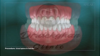 دندان قروچه را چطور کنترل کنیم؟