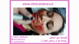 جوانسازی پوست با میکرونیدلینگ