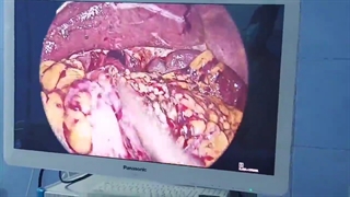 جراحی لاپاراسکوپی سرطان معده