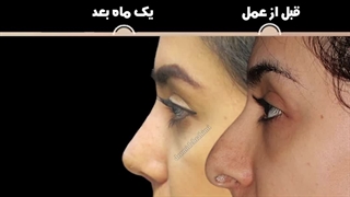 عمل زیبایی بینی | دکتر امید ابراهیمی