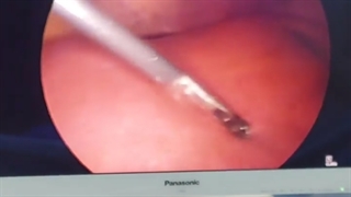 چاقی و بزرگی کبد یا هپاتومگالی