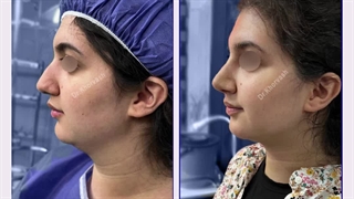 رضایت بیمار عزیز 10روز پس از رینوپلاستی و ساکشن گردن