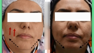 قیمت لیفت صورت با نخ چقدر است؟