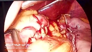 حجم معده بعد عمل اسلیو