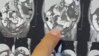 جراحی سرطان سیگمویید