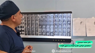 جراحی میکروسکوپی تومور مننژیوم توبرکولوم سلا