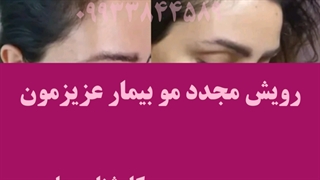 درمان قطعی ریزش مو