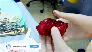 جراحی تومور اندومتریوز جدار شکم