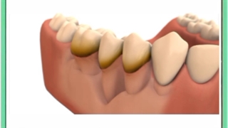 همه چیز درباره جراحی لثه یا پریو روکش دندان