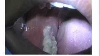 اقدامات پس از جراحی دندان عقل چیست؟