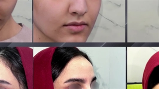 جراحی زیبایی بینی اولیه