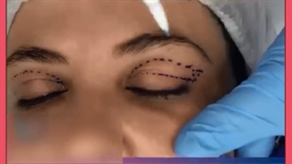 هزینه عمل بزرگ کردن چشم چیست؟