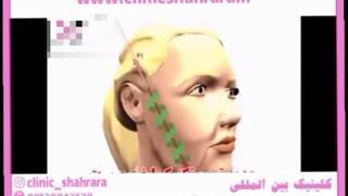 بهترین و معروفترین دکتر لیفت با نخ دکتر محمد علیزاده