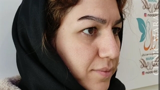 بلفاروپلاستی نچرال ولی با تغییر زیاد-کلینیک Vip تهران
