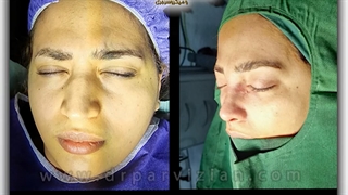 بلافاصله پس از جراحی زیبایی بینی