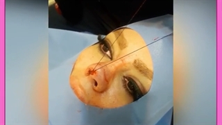 لیفت بینی گوشتی با نخ