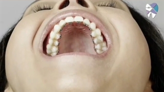 انواع ارتودنسی نامرئی.متخصص ارتودنسی تهران دکترعلیرضاخدیوی