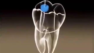 عصب کشی دندان