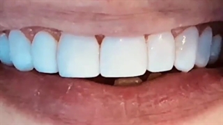 نمونه کار اصلاح طرح لبخند | دکتر سعید میرزایی