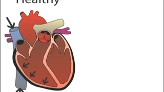 How to Measure Pulsus Paradoxus - (Real Patient!) - Stanford Medicine 25