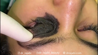 جراحی خال بوسنده