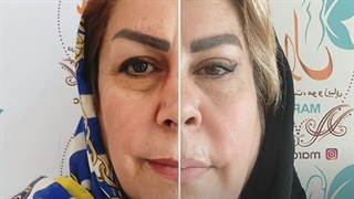 برداشتن چربی اضافه پشت پلک- کلینیک vip تهران