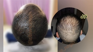 اسکالپ سر 09336093000 گرگان گنبد کردکوی بهشهر بندرگز گلوگاه علی آباد