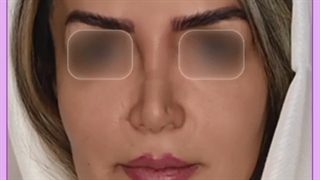 لیفت بینی با نخ و یا تزریق ژل توسط دکتر علیزاده