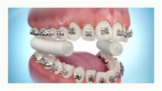 ارتودنسی چگونه دندان ها را صاف می کند؟