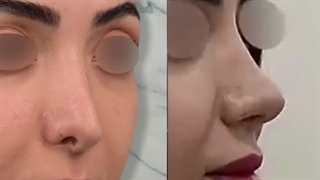 جراحی زیبایی بینی ترمیمی