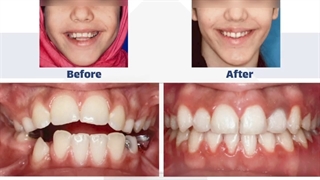 نمونه کار دکتر نگار حدادی متخصص ارتودنسی