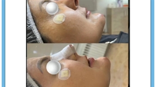 لیفت بینی با نخ در کرمان