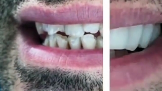 نمونه کار اصلاح طرح لبخند | دکتر سعید میرزایی