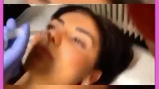 فیلم لیفت بینی با نخ