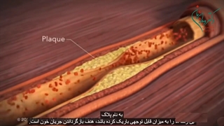 آنژیوپلاستی عروق کرونری