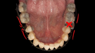 ارتودنسی بجای ایمپلنت | دکتر داودیان
