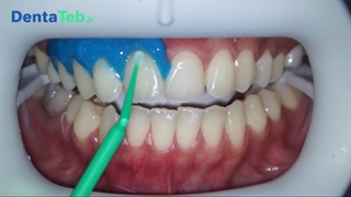 بلیچینگ دندانپزشکی چیست؟